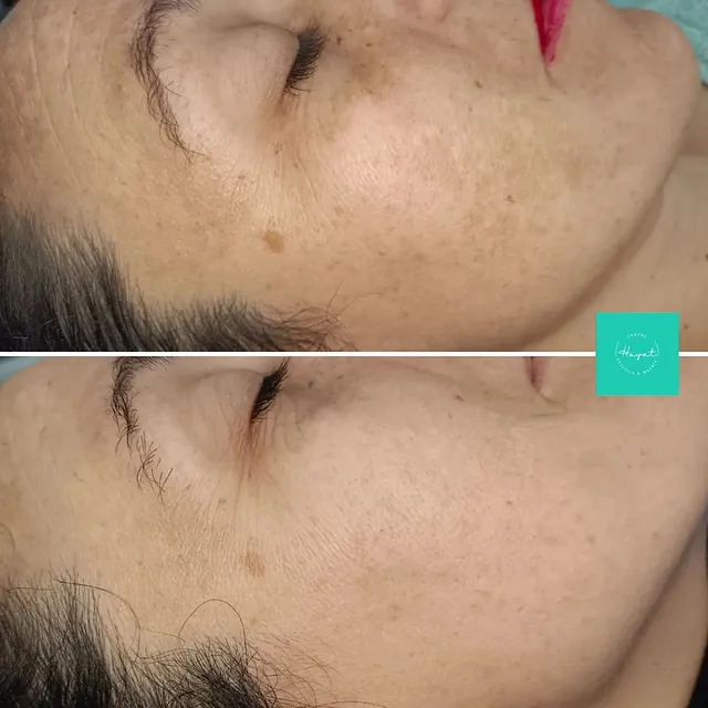 Tratamiento facial