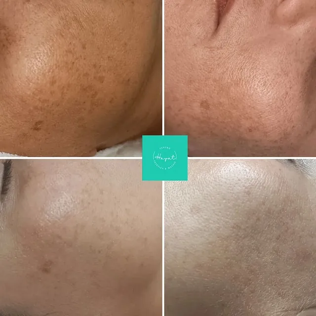 Tratamiento facial