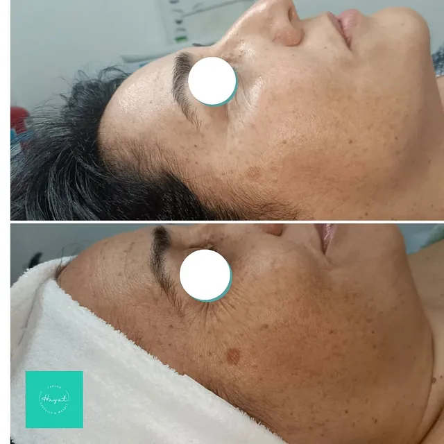 Tratamiento facial